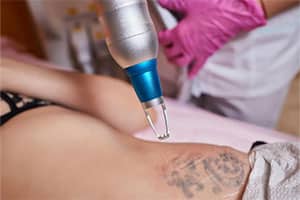 eliminacion de tatuajes